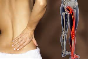 Sciatica 1
